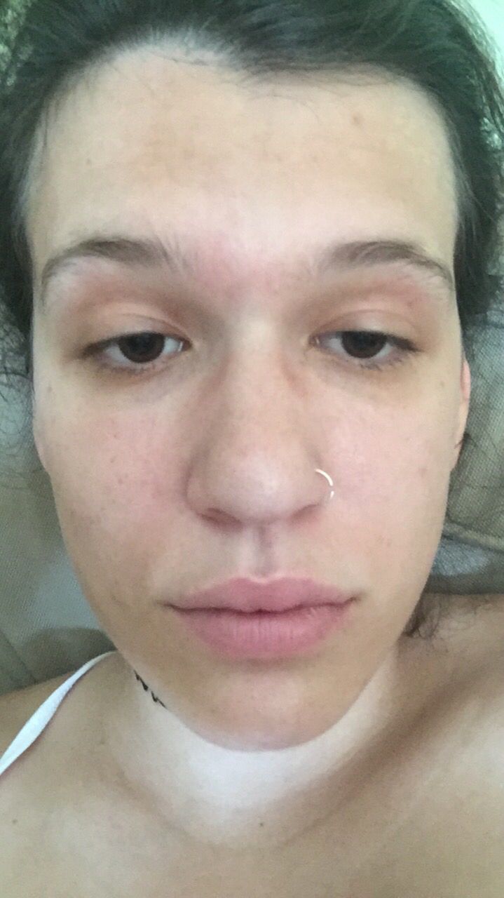 tips for white heads on face and black h... Beauty Insider Community