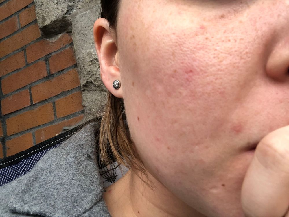 products for large pores and acne scars