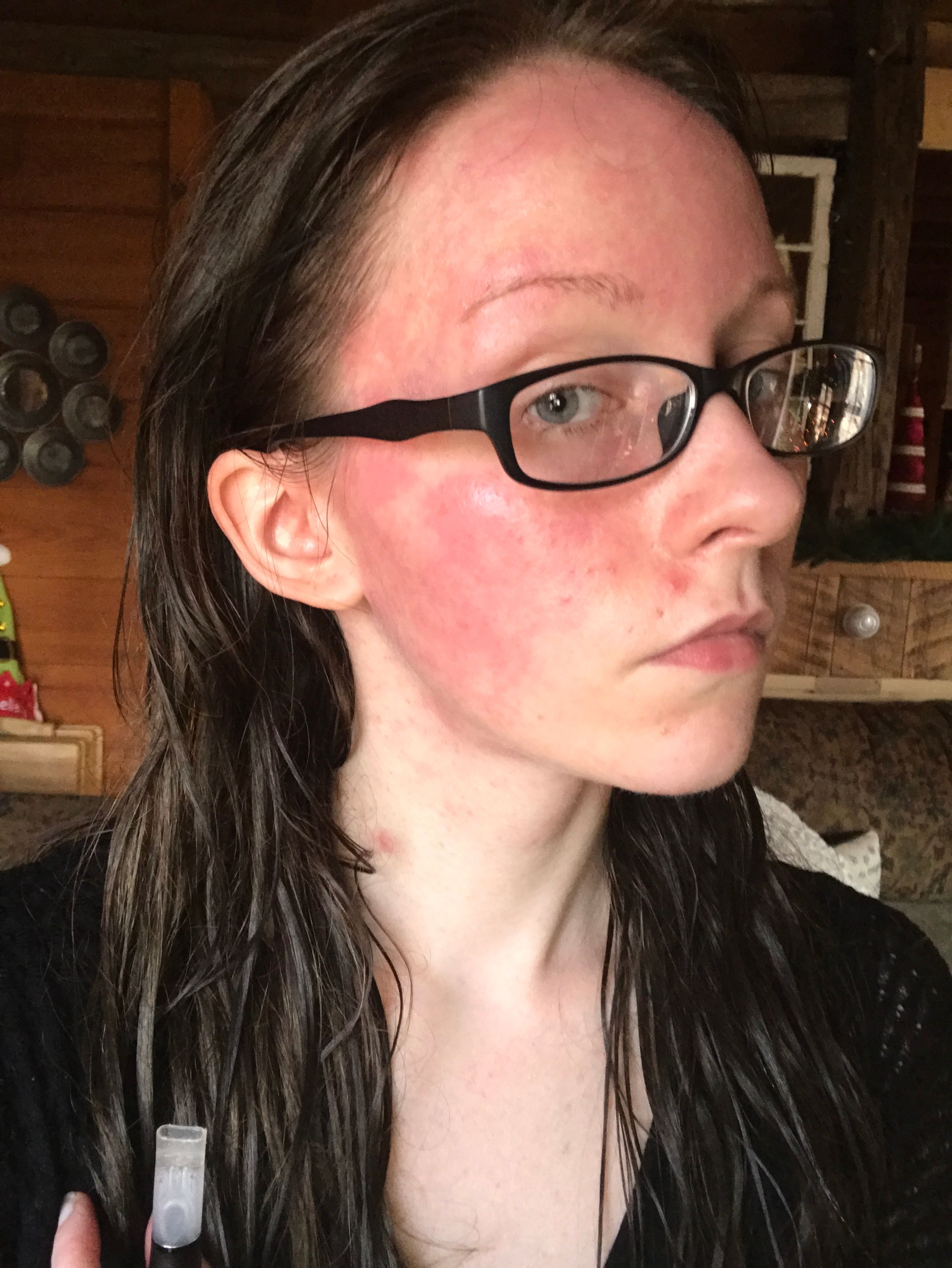 Sensitive skin or allergic reaction? Beauty Insider Community