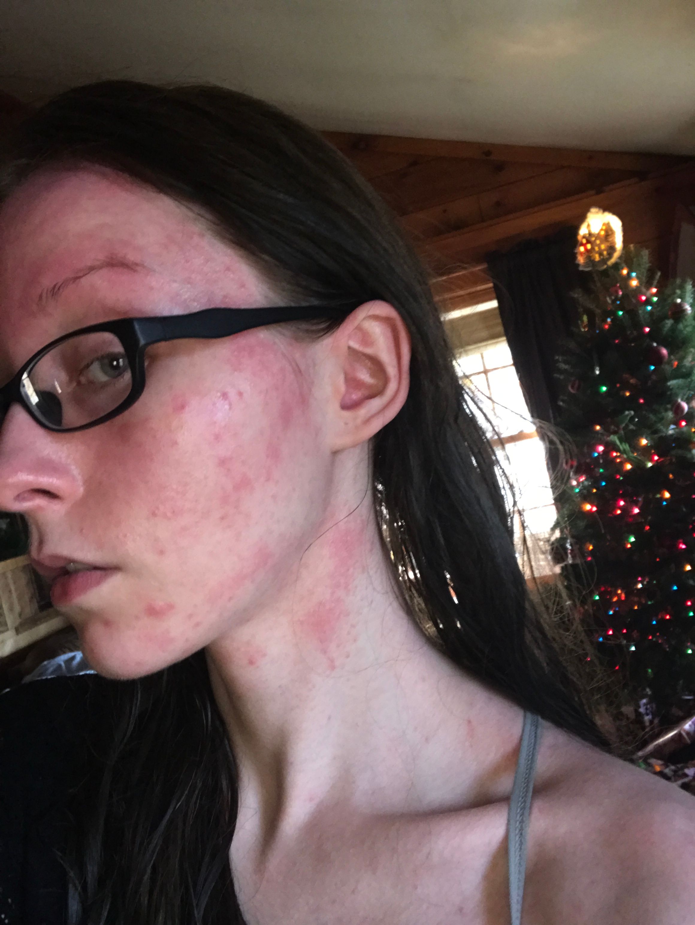 Sensitive skin or allergic reaction? - Beauty Insider Community