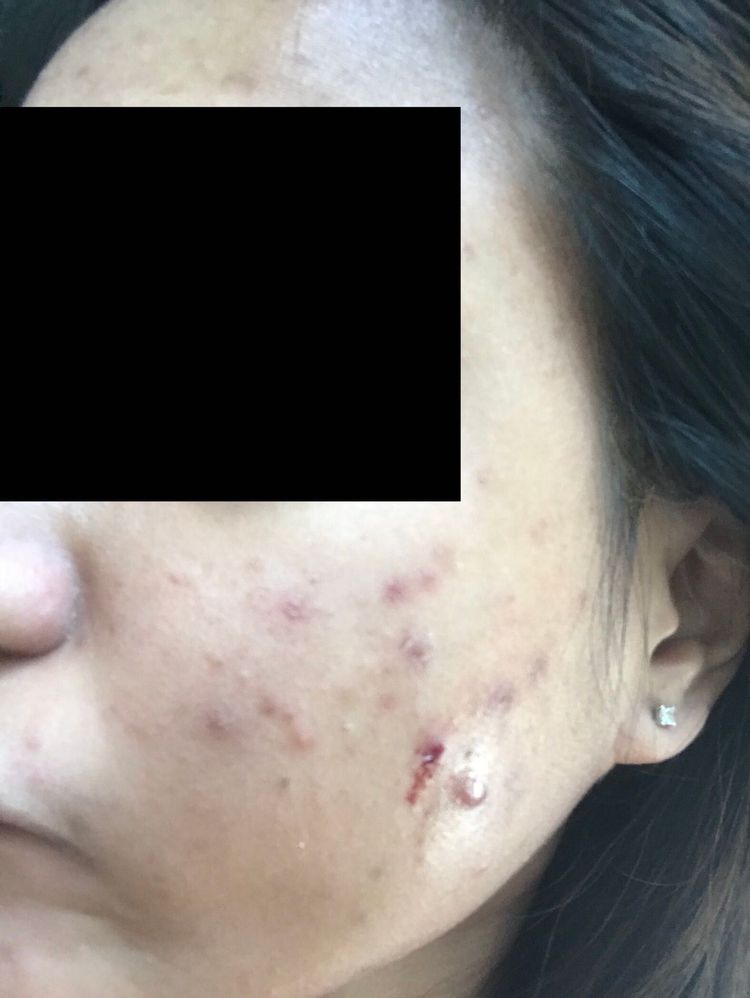 sunday riley acne scars