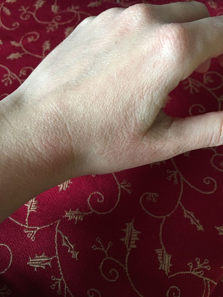 lotion not helping dry hands